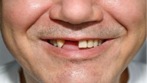 Nằm mơ thấy rụng răng – Nên đánh con gì để có vận may thắng lớn?